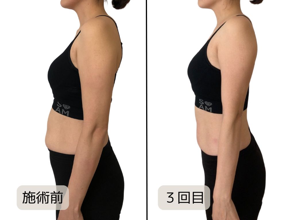 痩身効果の写真(練馬の痩身サロン|優子さんの美容矯正サロン)